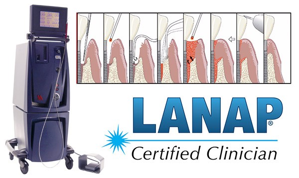 LANAP Laser Treatments