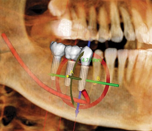 dental implants charleston2