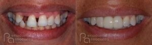 periodontal-associates_charleston_implant-restoration_patient1a