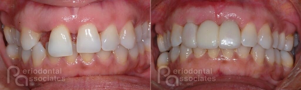 periodontal-associates_charleston_implant-restoration_patient1b