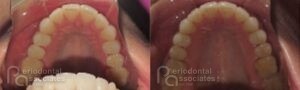 periodontal-associates_charleston_paoo_patient1d
