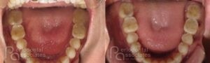 periodontal-associates_charleston_paoo_patient1e