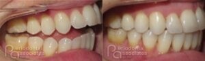 periodontal-associates_charleston_paoo_patient1f