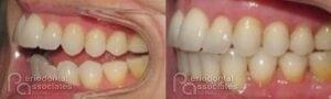 periodontal-associates_charleston_paoo_patient1h