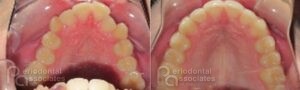 periodontal-associates_charleston_paoo_patient2a