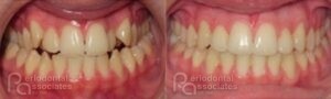 periodontal-associates_charleston_paoo_patient2d