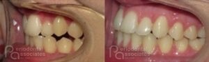 periodontal-associates_charleston_paoo_patient2e