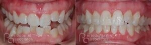 periodontal-associates_charleston_paoo_patient3a