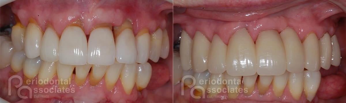 periodontal-associates_charleston_periodontal-disease_patient1a