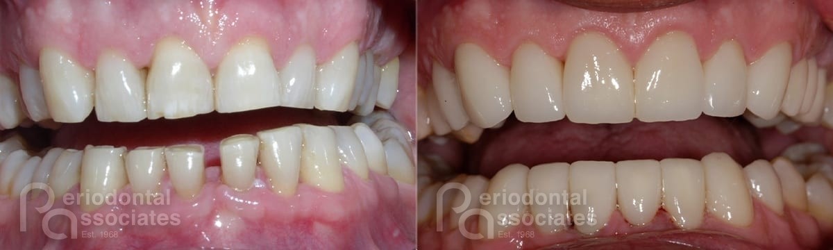 periodontal-associates_charleston_periodontal-disease_patient2a