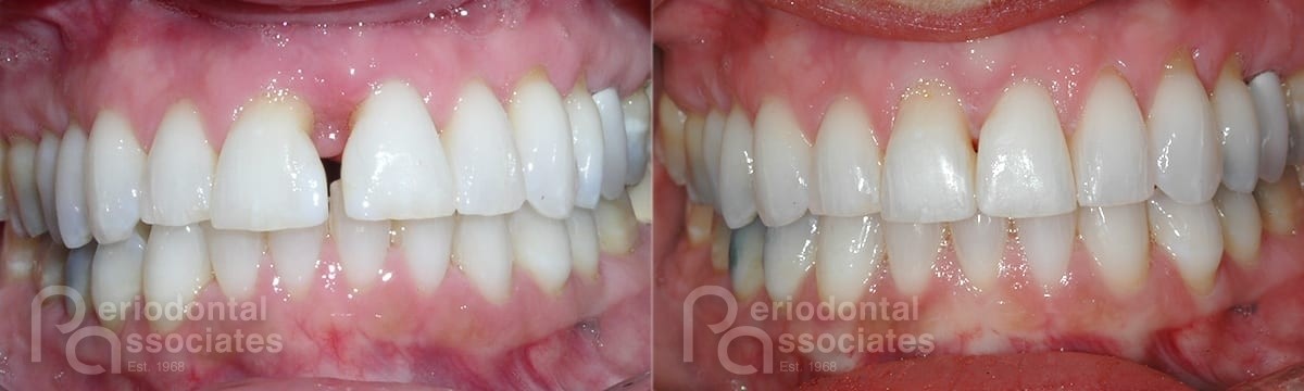 periodontal-associates_charleston_periodontal-disease_patient3a
