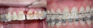 periodontal-associates_charleston_periodontal-disease_patient3b