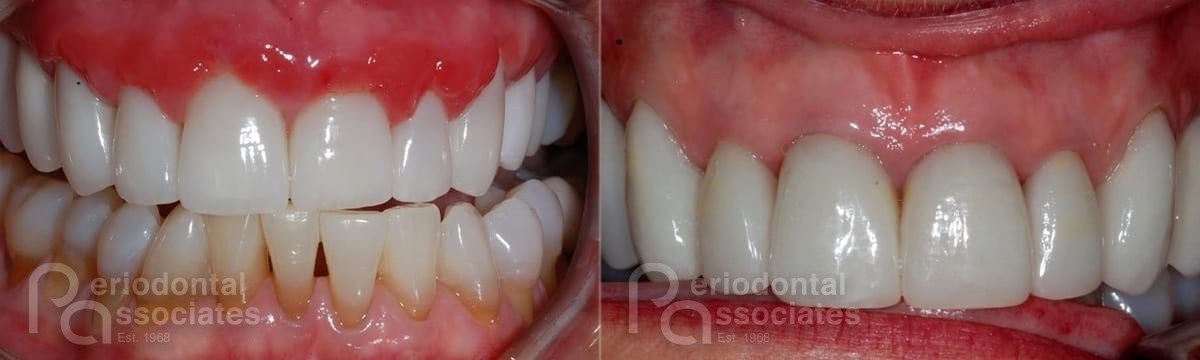 periodontal-associates_charleston_periodontal-disease_patient5a