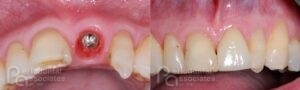 periodontal-associates_charleston_single-implant_patient1a