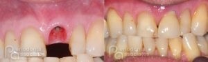 periodontal-associates_charleston_single-implant_patient1b