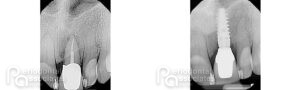 periodontal-associates_charleston_single-implant_patient1c