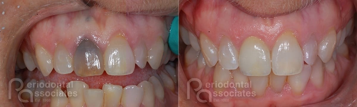 periodontal-associates_charleston_single-implant_patient2a