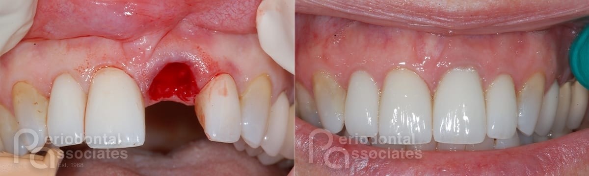 periodontal-associates_charleston_single-implant_patient3a