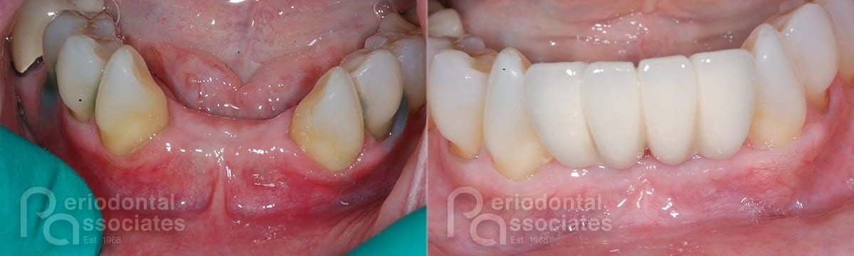 periodontal-associates_charleston_single-implant_patient5a