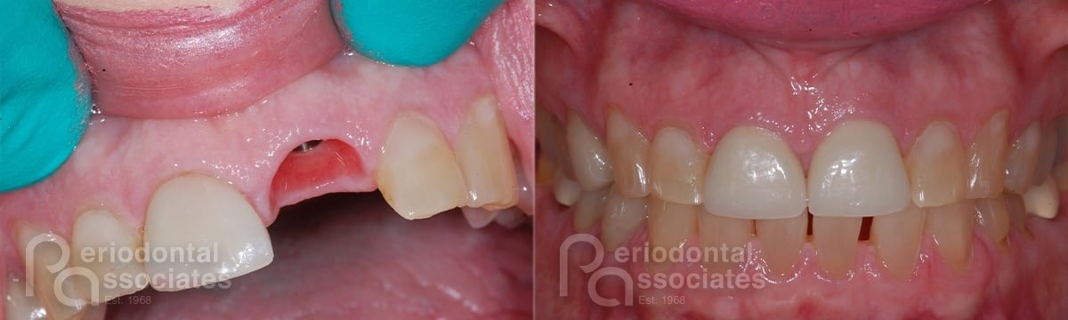 periodontal-associates_charleston_single-implant_patient6a