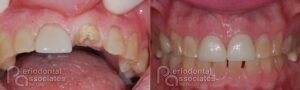 periodontal-associates_charleston_single-implant_patient6b