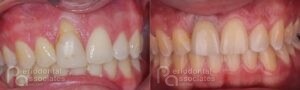 periodontal-associates_charleston_single-implant_patient7a