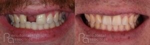 periodontal-associates_charleston_single-implant_patient7b