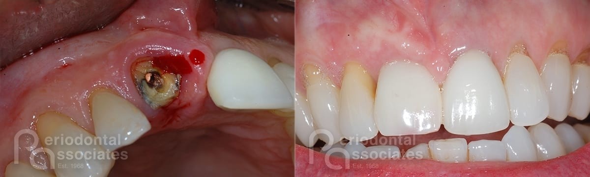 periodontal-associates_charleston_single-implant_patient8a