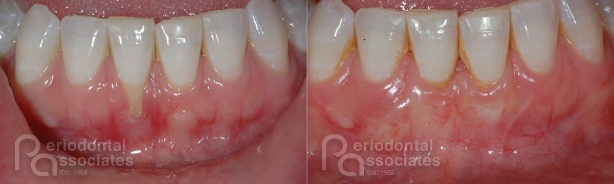periodontal-associates_charleston_tissue-graft_patient1a