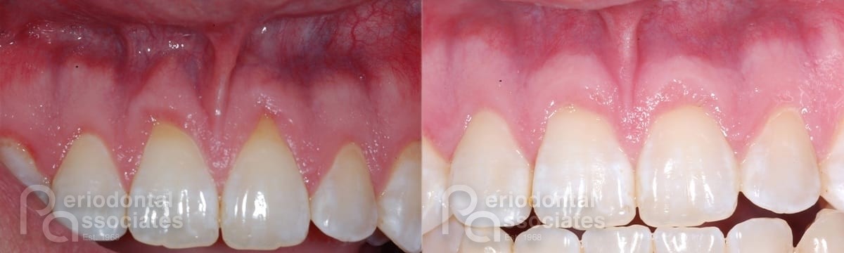 periodontal-associates_charleston_tissue-graft_patient4a